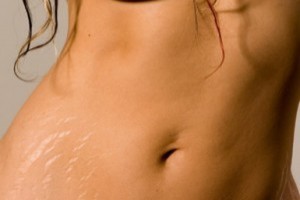 Стрии (растяжки) – одна из основных проблем современных женщин. Что такое растяжки и как избавить свою кожу от них.