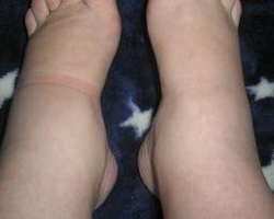 Причины и женские симптомы: отек ног